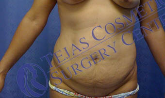 Tummy-Tuck-before surgery