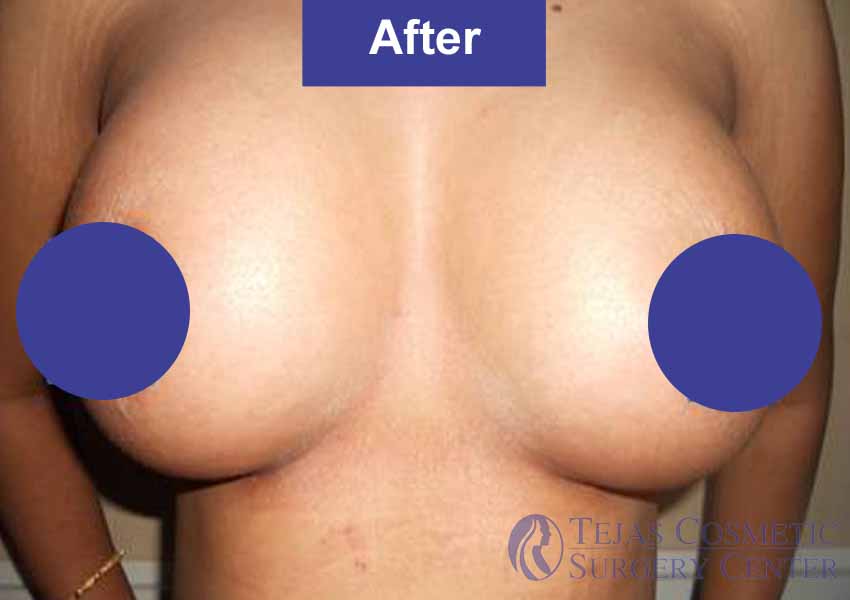 breast implant after copy
