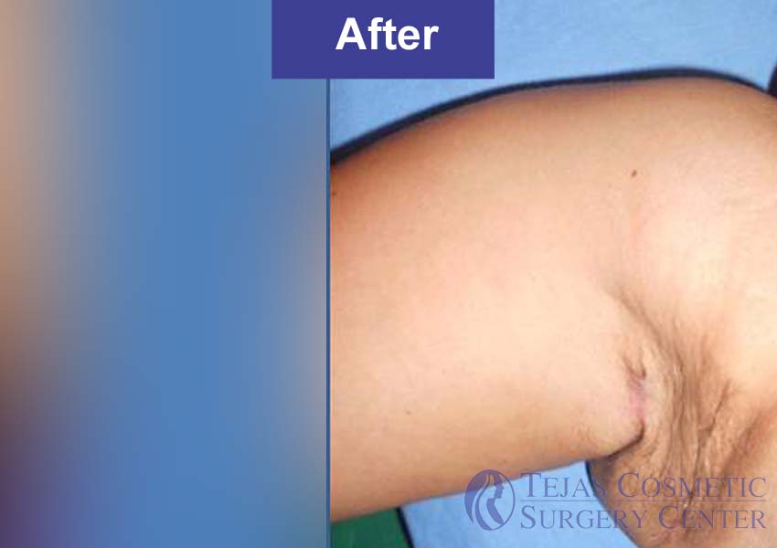 liposuction of auxillary breast after