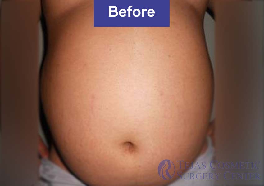 liposuction of male abdomen before