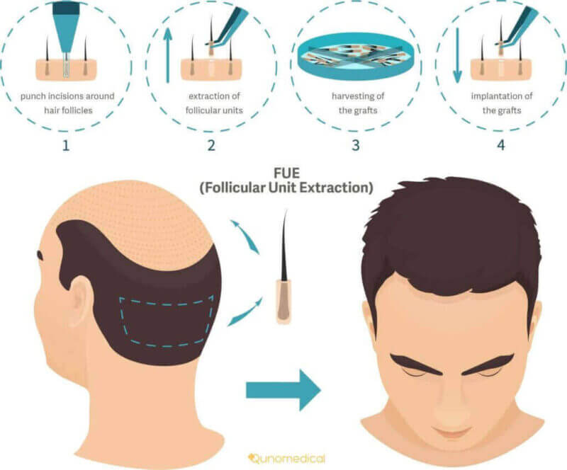 Top 10 HAIR TRANSPLANT in Trichy Manufacturers Exporters Suppliers  Service Companies in Trichy  Useityellowpages