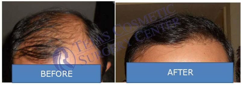 Hair Transplant in Coimbatore, PRP Hair Treatment Clinic in Coimbatore