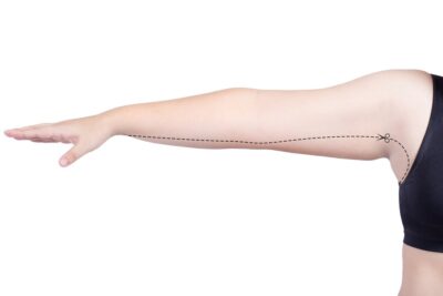 Liposuction Cost in Coimbatore Best Liposuction Surgeon in Coimbatore