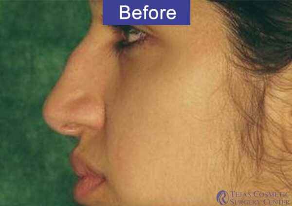 Rhinoplasty Surgery in Coimbatore