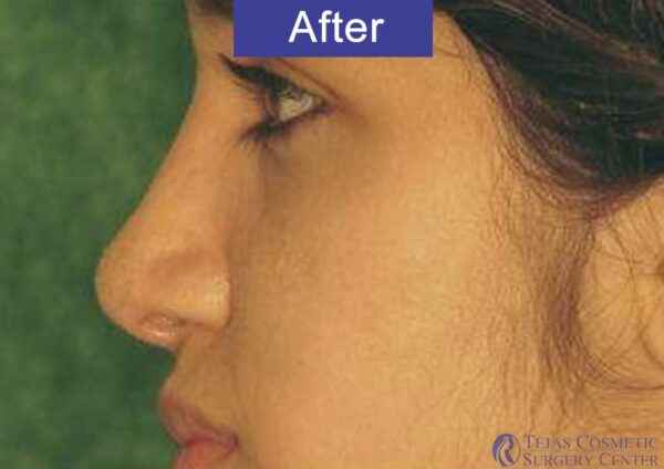 Nose Plastic Surgery in Coimbatore