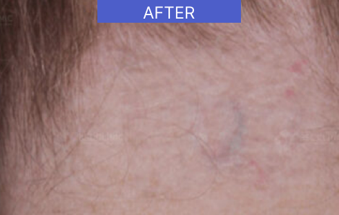 after-tattoo-removal-back-neck