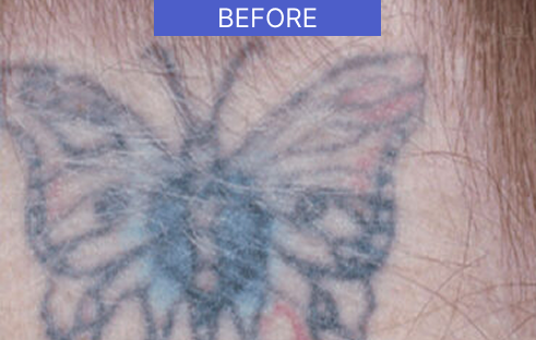before-tattoo-removal-back-neck