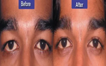 blepharoplasty-results blepharoplasty-results