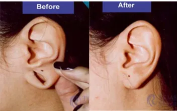 earlobe-repair-surgery-results earlobe-repair-surgery-results