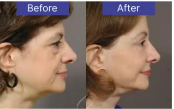 fat-injection-results fat-injection-results