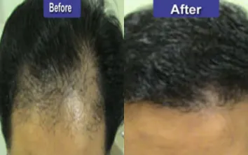 hair-transplant-results hair-transplant-results