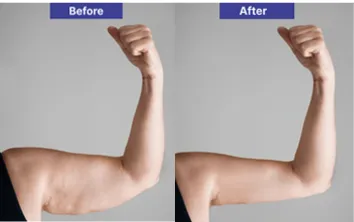 liposuction-of-arms liposuction-of-arms