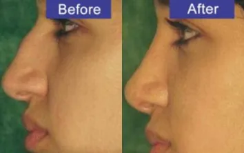 nose-plastic-surgery-results nose-plastic-surgery-results